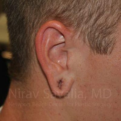 Case--1655727 | Before Torn Earlobe Repair Ear Gauge Repair